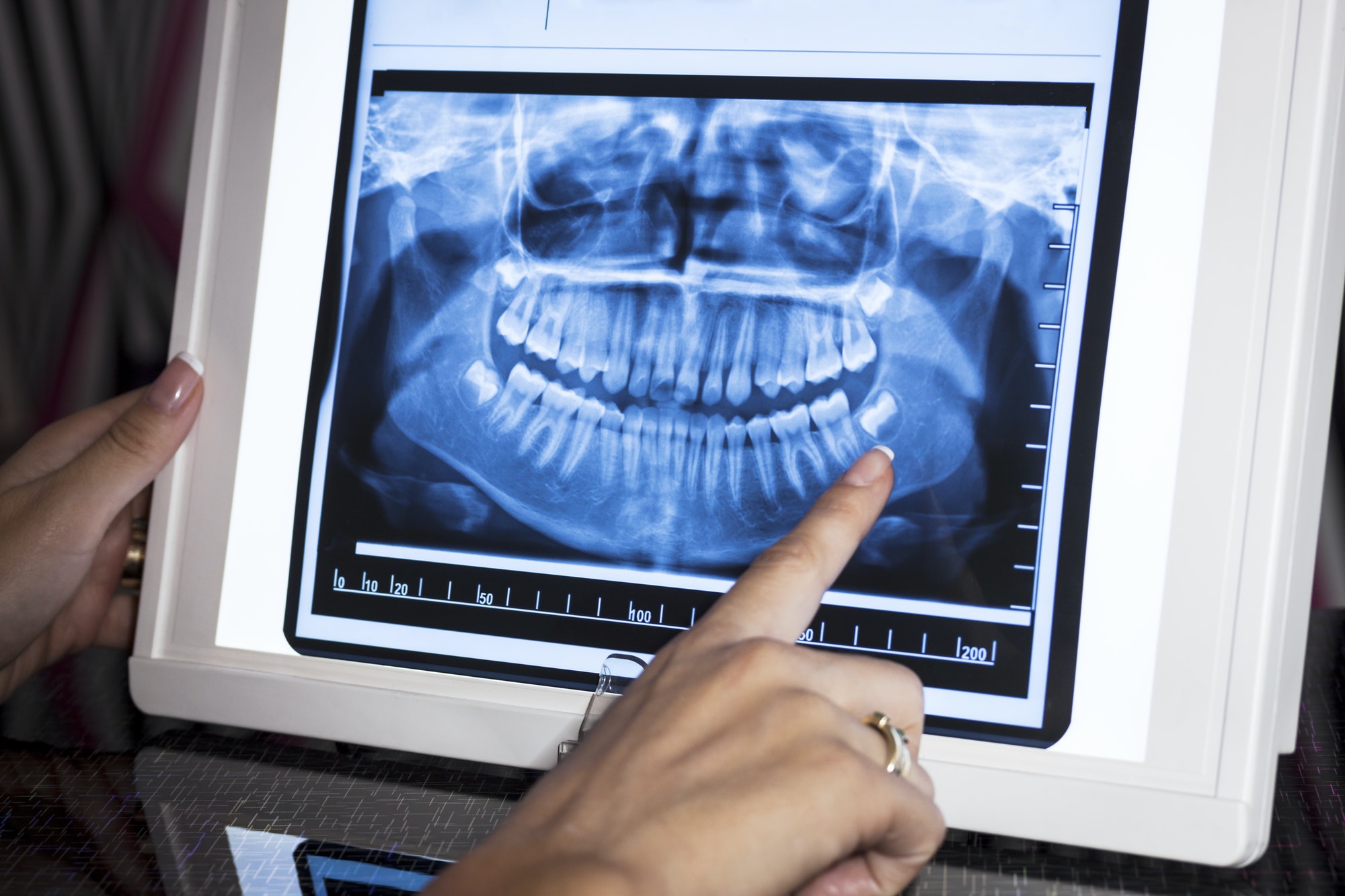 Dental X-Rays - Radiografías Dentales