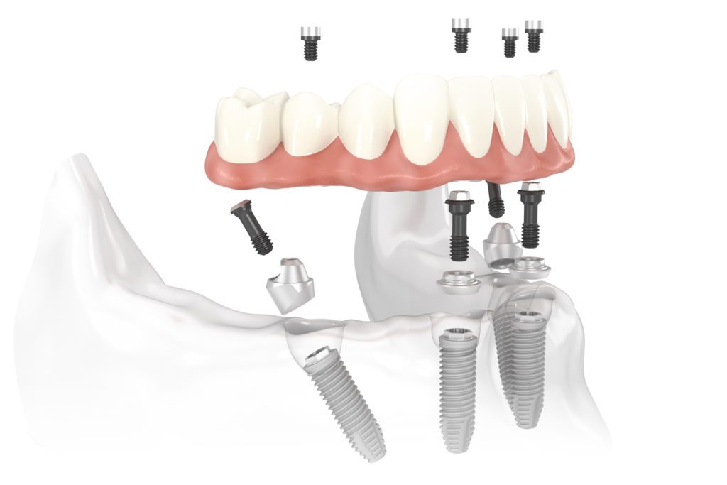 Implantes Dentales ALL ON 4