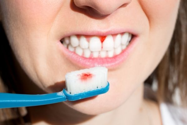 HOW TO REVERSE PERIODONTITIS