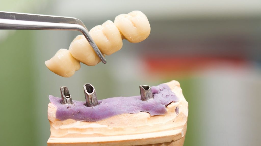 dental bridge