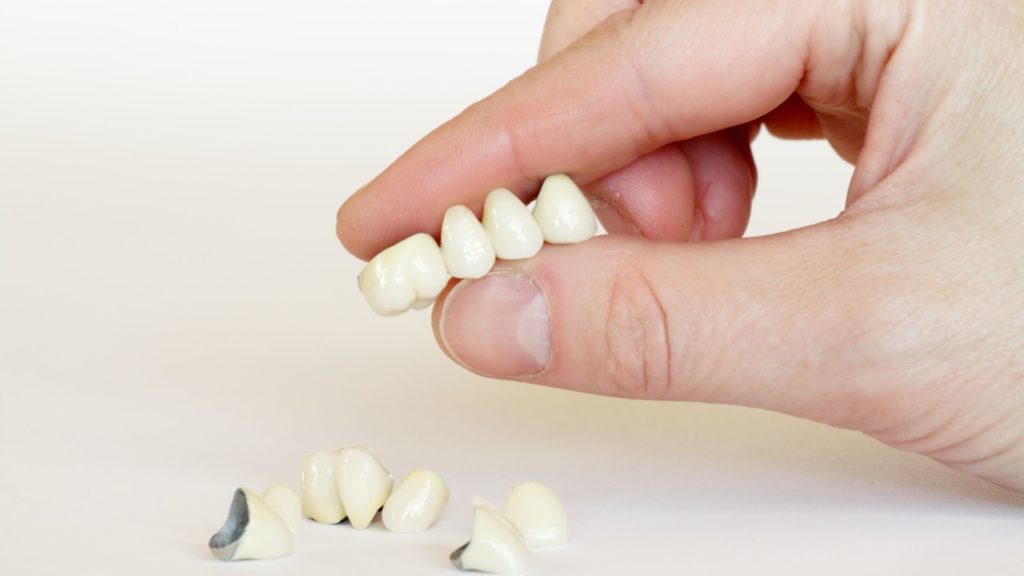 dental bridge