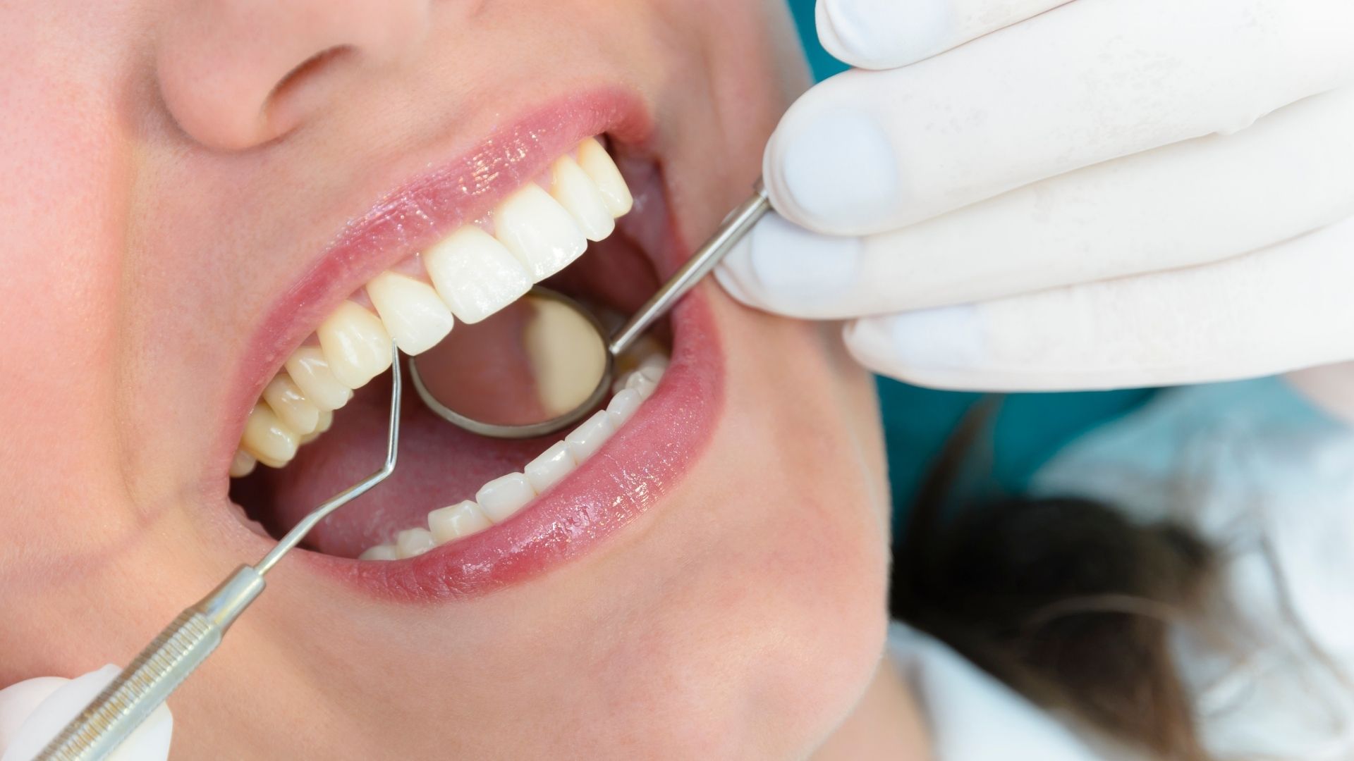 dental fillings