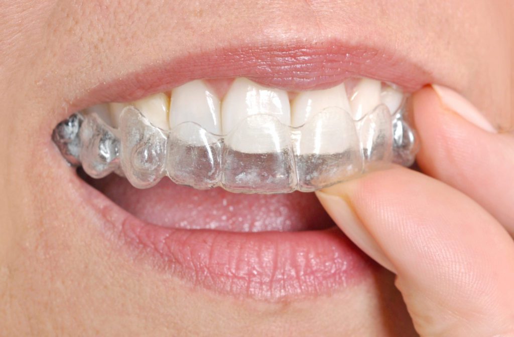 ALINEADORES INVISALIGN