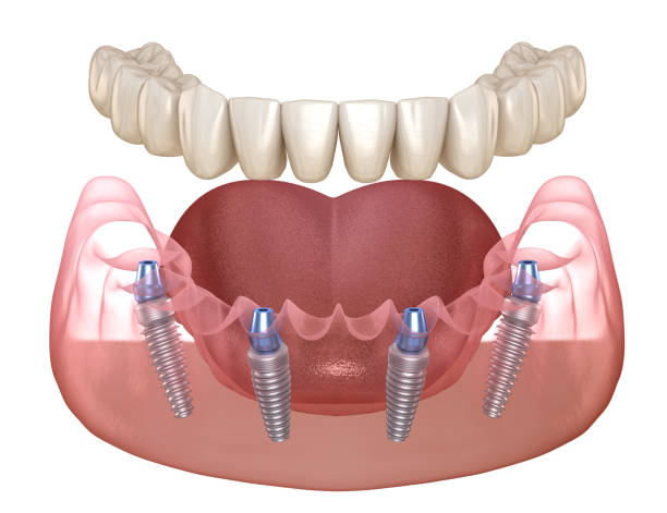 Animation of dental implant