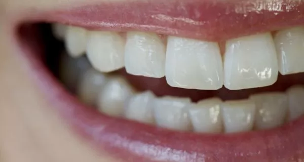 Benefits of choosing snap-on smile