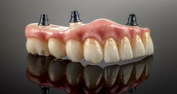 Overdentures: what most people know as snap-in dentures