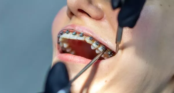 The orthodontic process: what to expect