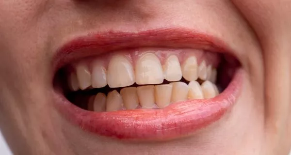 Who is teeth whitening for?