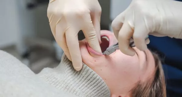 How we perform wisdom teeth removal in Port Hueneme