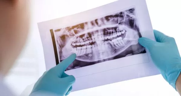 Why is it important to remove wisdom teeth?