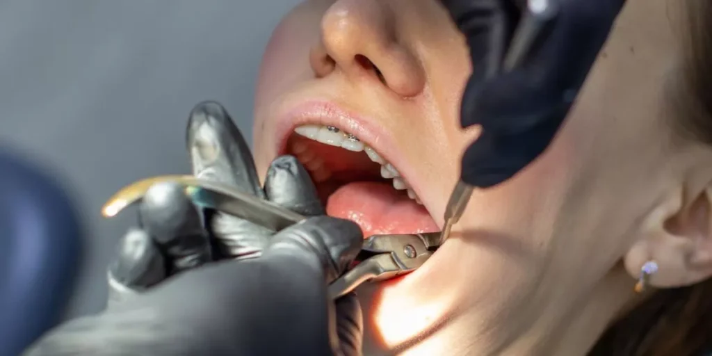Wisdom Teeth Removal in Port Hueneme