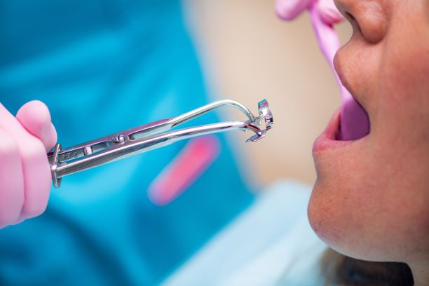 Root canal